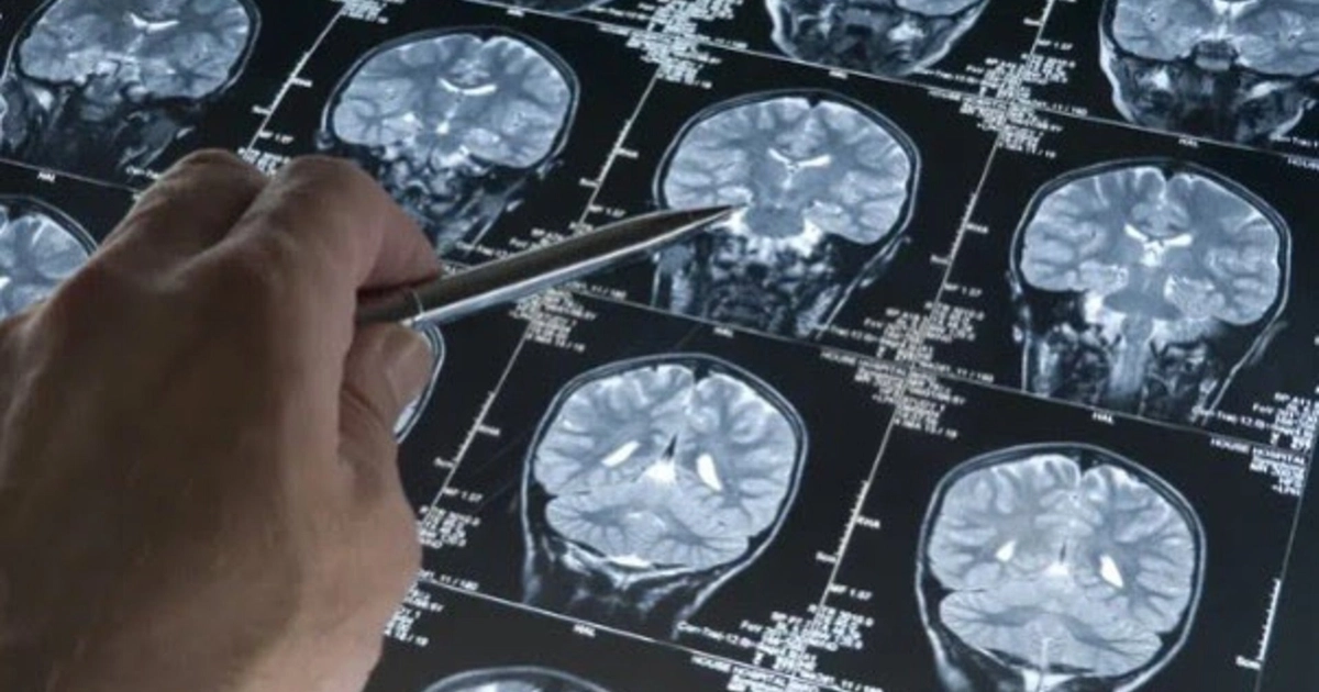 El Alzheimer afecta a unos 50 millones de personas en el mundo y podría alcanzar los 152 millones para el año 2050 según proyecciones científicas /Europa Press