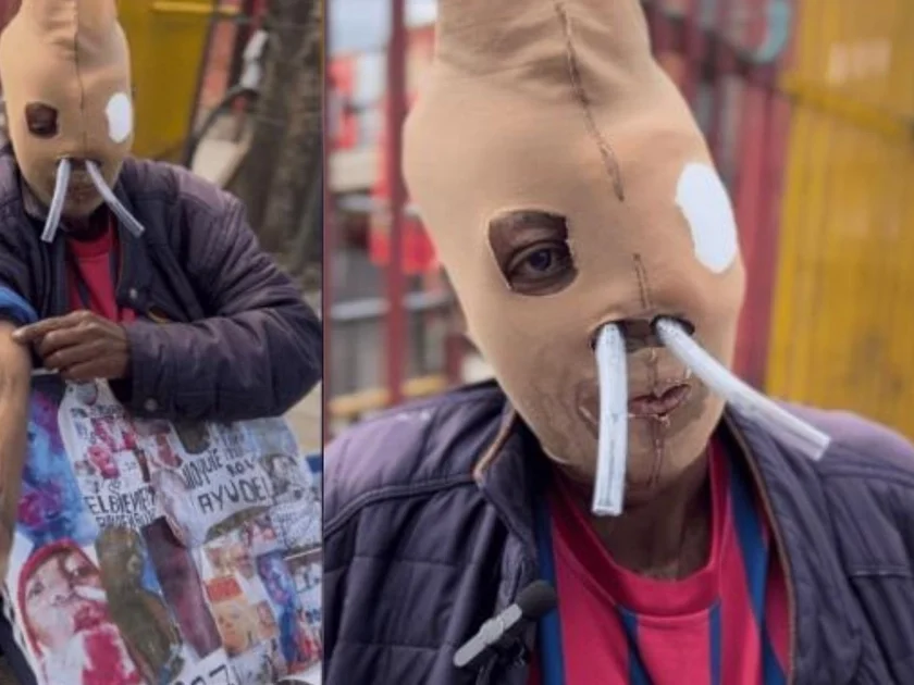 María Consuelo Córdoba ha relatado las dificultades que ha enfrentado durante más de dos décadas tras la agresión con ácido. - crédito captura de video Citytv