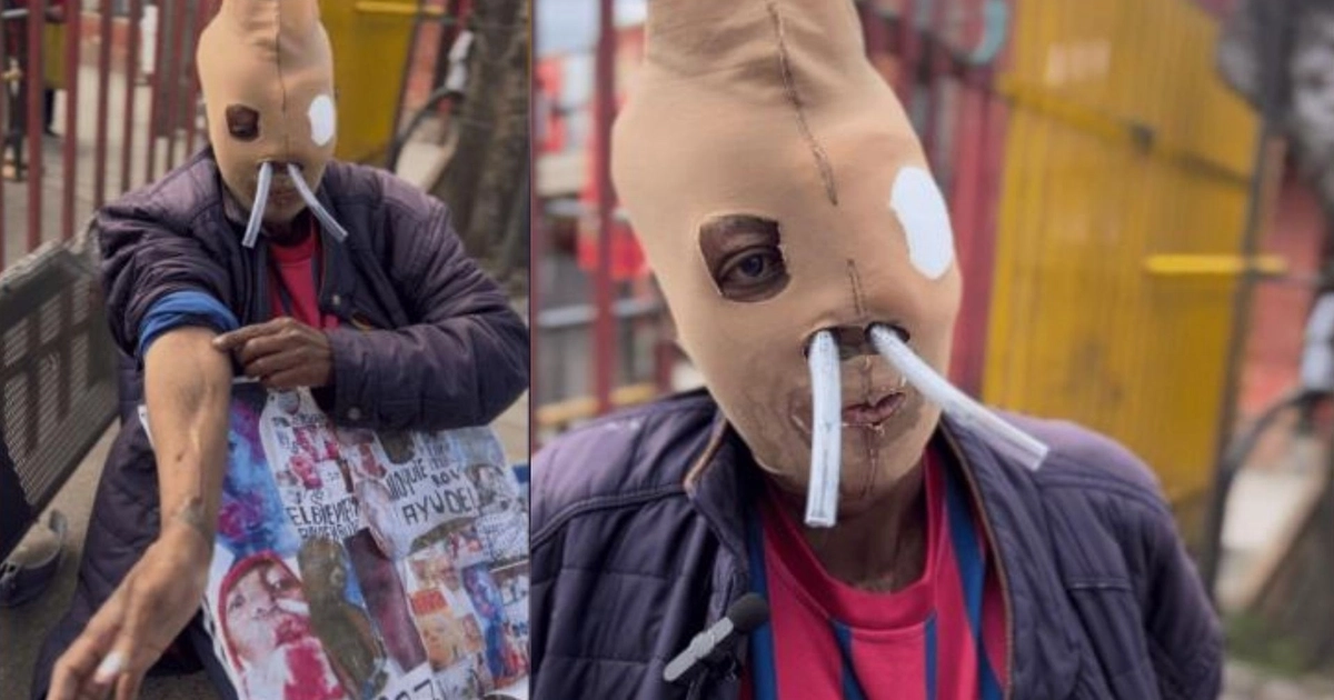 María Consuelo Córdoba ha relatado las dificultades que ha enfrentado durante más de dos décadas tras la agresión con ácido. - crédito captura de video Citytv